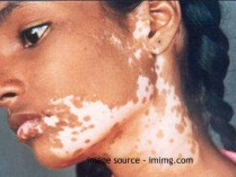 Leucoderma Causes and Remedies