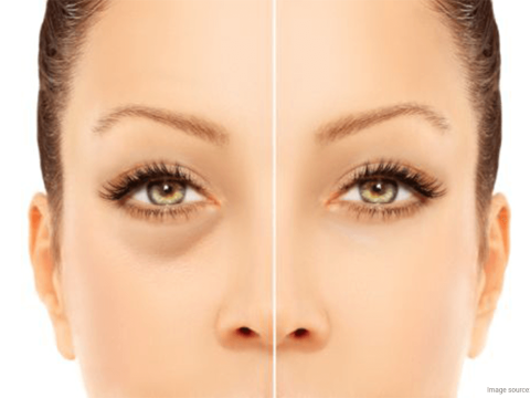 How to Remove Dark Circles: 5 Natural Home Remedies