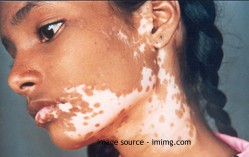 Leucoderma Causes and Remedies
