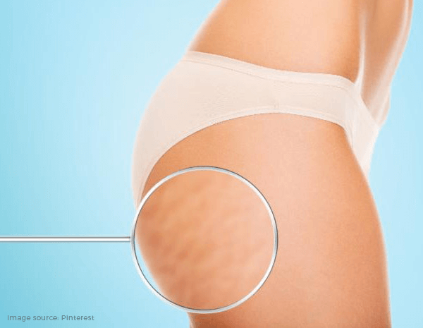 How to get rid of stretch marks
