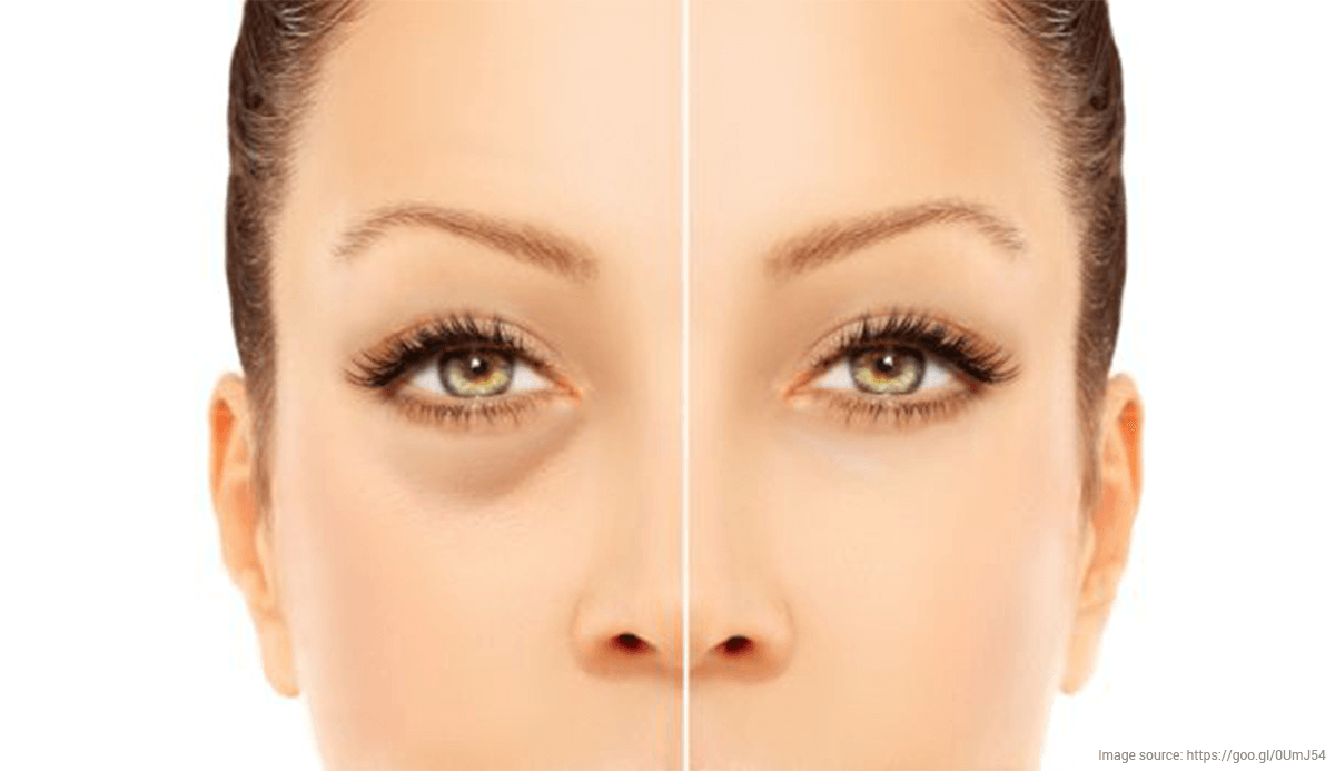 How to Remove Dark Circles: 5 Natural Home Remedies