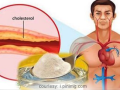 High Cholesterol: Causes, Effects and Treatment